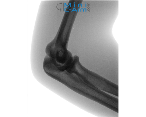Hologic Fluoroscan InSight FD mini c arm elbow